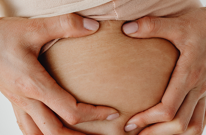 ELLE DIT: Je n'aimais pas mes vergetures post-grossesse mais j'y ai grandi